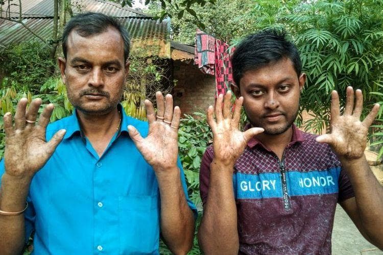 Amal Sarker dan Appu Sarker menunjukan tangannya yang nggak memiliki sidik jari. (BBCIndonesia)<br>