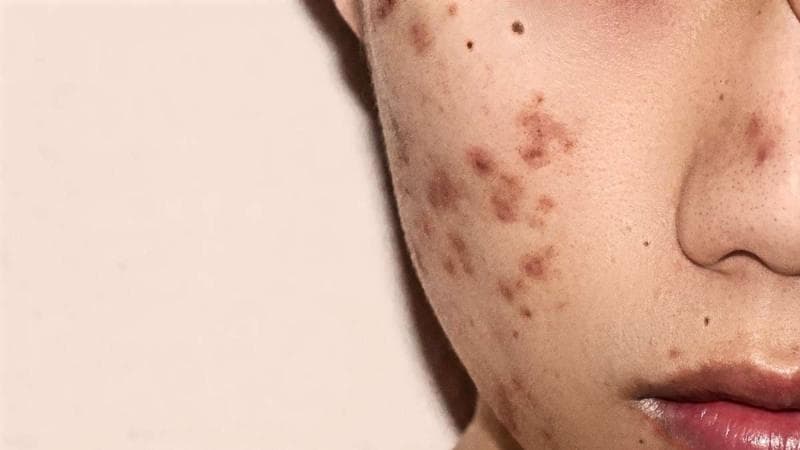 Dear Pejuang Muka Mulus, Ini 6 Cara Paling Ampuh Hilangkan Jerawat!