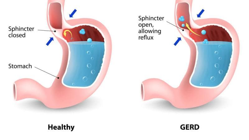 Ilustrasi GERD. (Klikdokter)