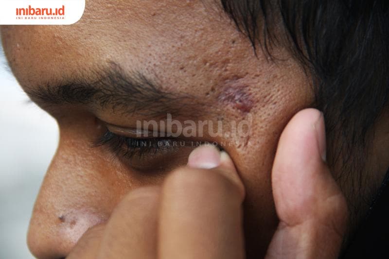 Pilih Skincare Wajah Berjerawat, Pastikan Mengandung Zat-Zat Berikut!