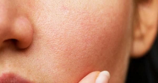 Pori-pori besar dipengaruhi faktor usia. (Freepik)