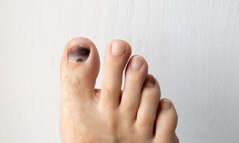 Cantengan bisa menyebabkan infeksi. (Shutterstock via Okezone)