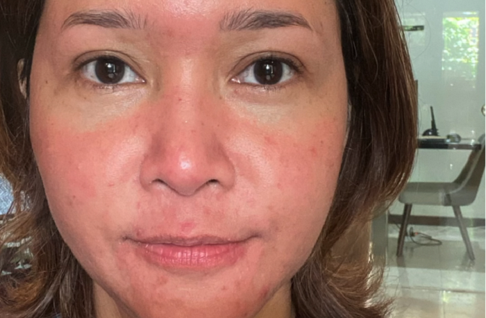 Kondisi rosacea Maia Estianty. (via Merdeka)