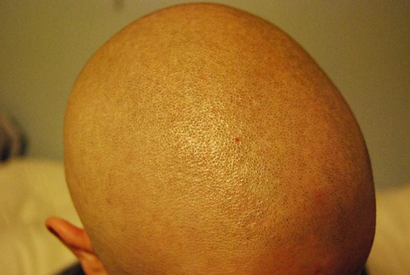 Orang Botak Masih Butuh Sampo, Ini Alasannya!