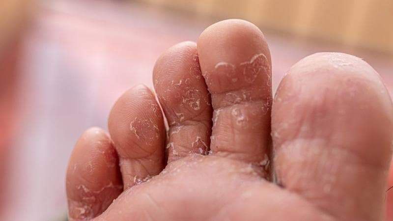 Ilustrasi kutu air. (shutterstock)