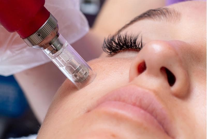 Tahapan facial vampir yaitu mengambil darah kita untuk dipisahkan plasma darahnya, lalu disuntikkan lagi ke wajah. (Northshoremedicalclinic)