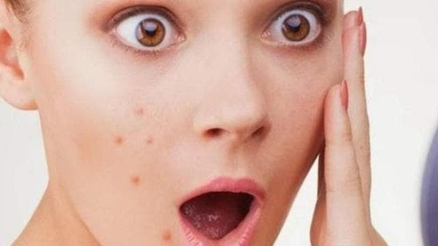 Wajahmu bakal mudah berjerawat kalau nggak cocok pakai sabun muka tertentu. (via Liputan6)