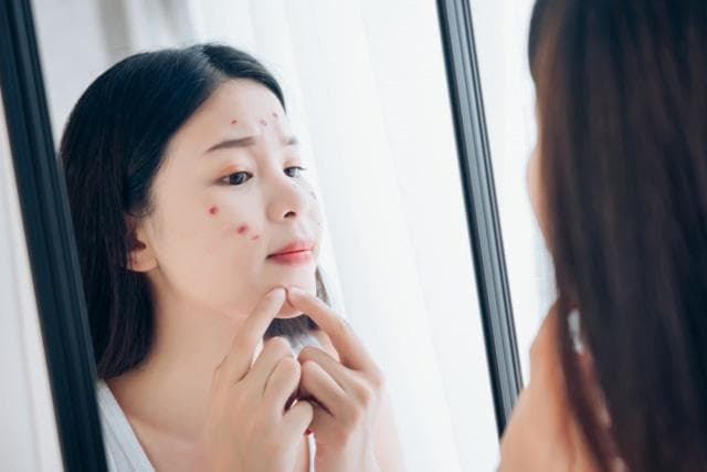 Perubahan hormon usai menstruasi bisa menyebabkan jerawat. (Shutterstock via Kumparan)