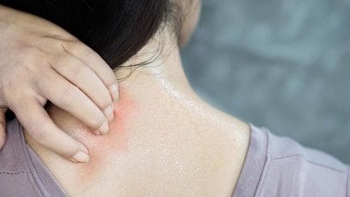 Kelembaban bisa bikin kulit lecet dan iritasi. (iStock via Tirto)