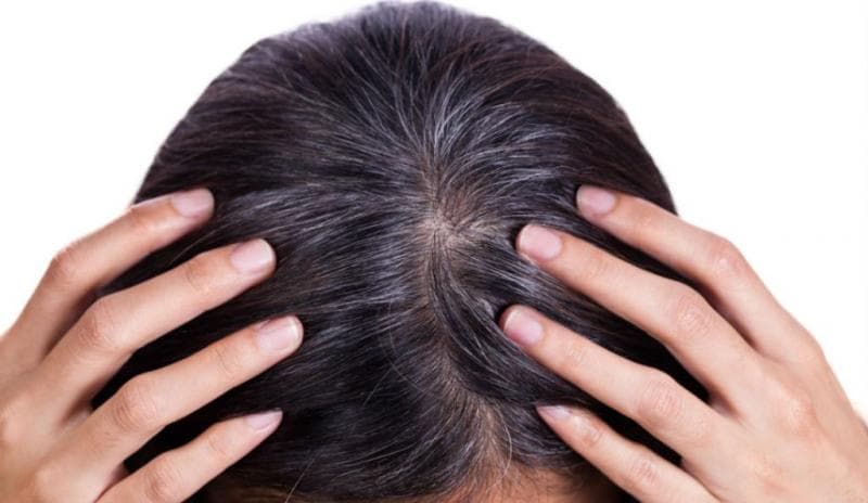 Jika uban dicabut, folikel rambutnya akan rusan. (Medcom/Inquistr)