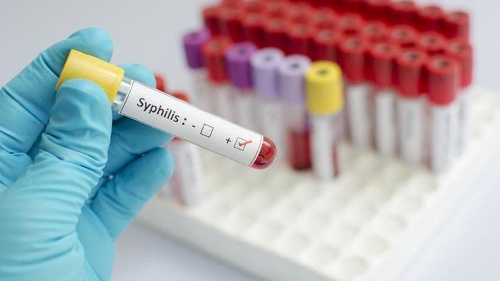 Sifilis bisa diobati. (Thinkstock)