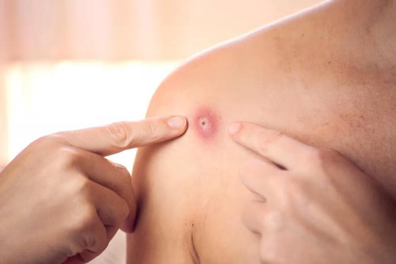 Bisul Bisa Menular, Beneran Nggak Sih?