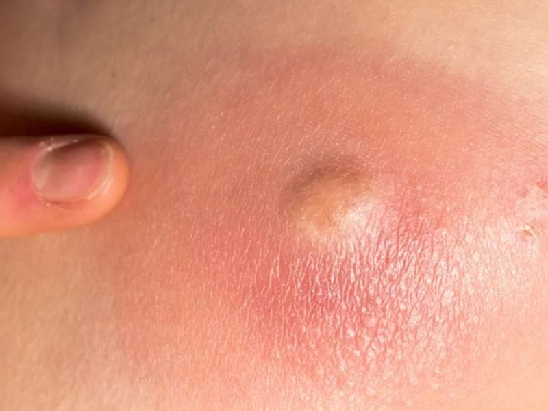 Bisul bisa mengeluarkan cairan yang berisi bakteri. (Medicalnewstoday)