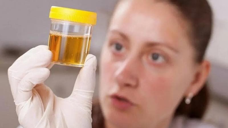 Terjawab, Alasan Urine Berwarna Kuning