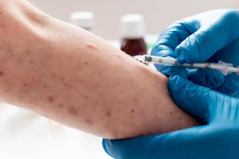 Virus Mpox bisa menular melalui kontak erat dengan cairan tubuh atau lesi kulit orang yang terinfeksi. (Disway)