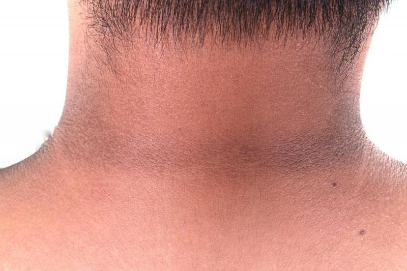 Akantosis nigrikans, salah satu tanda diabetes pada kulit. (Shutterstock/Rungnapa4289)