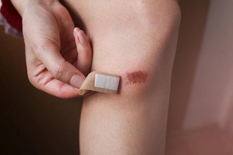 Luka sulit sembuh jadi tanda diabetes pada kulit. (Hansaplast)