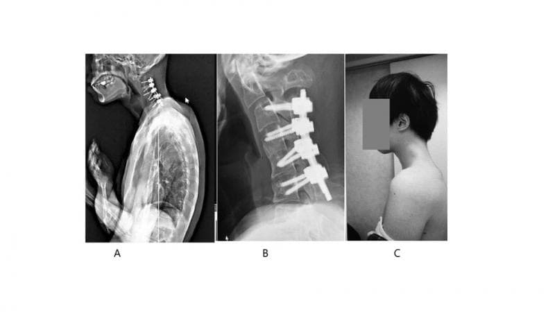 Pasien akhirnya dioperasi demi mengembalikan bentuk lehernya. (Tatsuya Shibata)