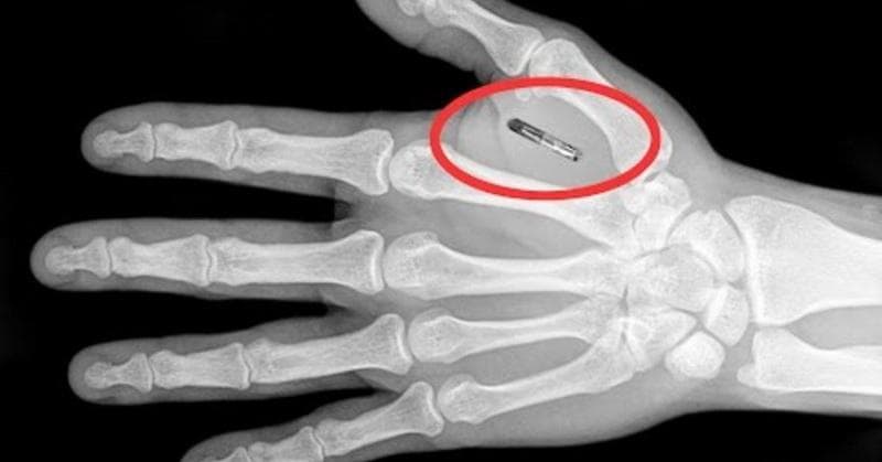 Chip yang dipasang berfungsi untuk pembayaran atau akses kunci rumah. (Bigthink)