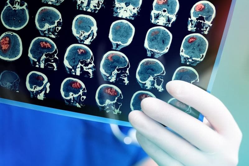 Menghadapi Stroke, Kecepatan Penanganan adalah 'Kunci'