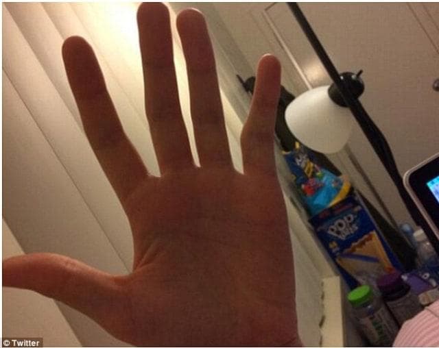 Awas Smartphone Pinky! Kelingking Cekung Akibat Genggam Ponsel Kelamaan