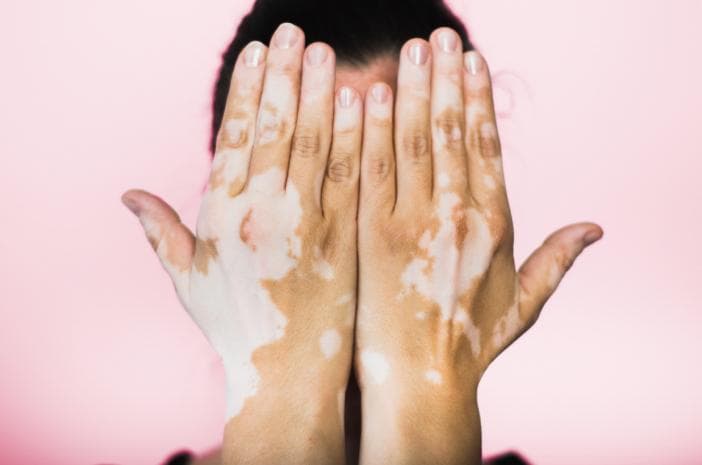 Pengidap vitiligo dengan bercak-bercak putih di kulit. (Halodoc)