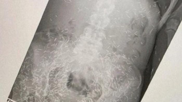 Susuk yang tampak dari pemeriksaan X-Ray. (instagram/@tasyabira)