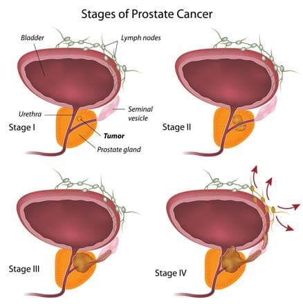 Gambar tahapan kanker prostat. (Parkwaycancercentre)