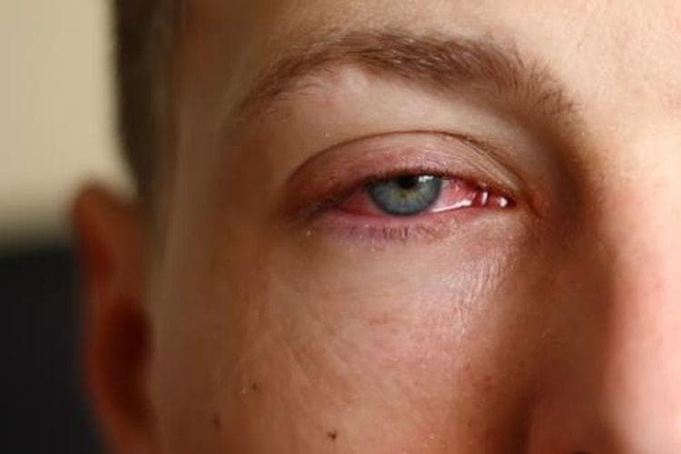 Mata merah bisa jadi menjadi indikasi gejala infeksi karena penggunaan lensa kontak. (Sharp via Kompas)
