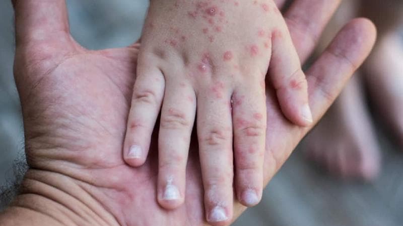 Epidemiolog: Cacar Monyet Berpotensi Sudah Masuk Indonesia