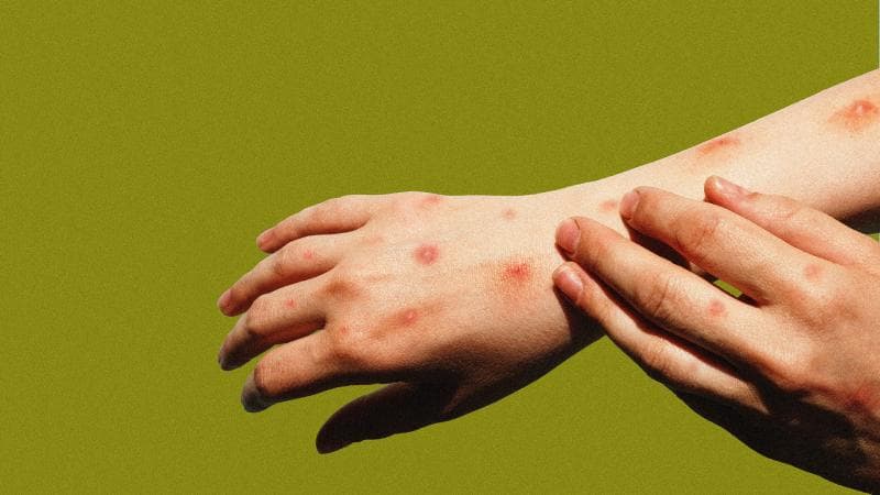 Status Cacar Monyet Menjadi Darurat Internasional, Yuk Waspadai Cara Penularannya!