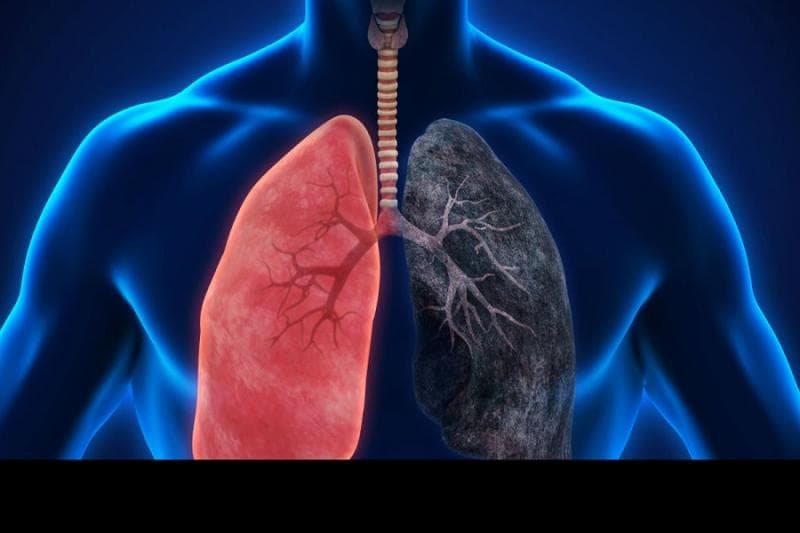 Berhenti merokok bisa membantu memperbaiki kondisi paru-paru? (regencyhealthcare)