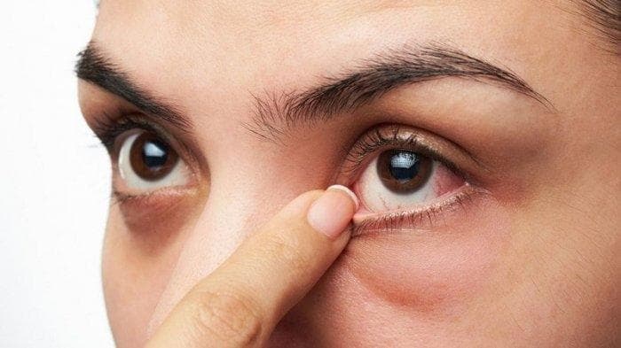 Bila terkena mata, uap cairan antiseptik bisa merusak mata. (Fotolia)